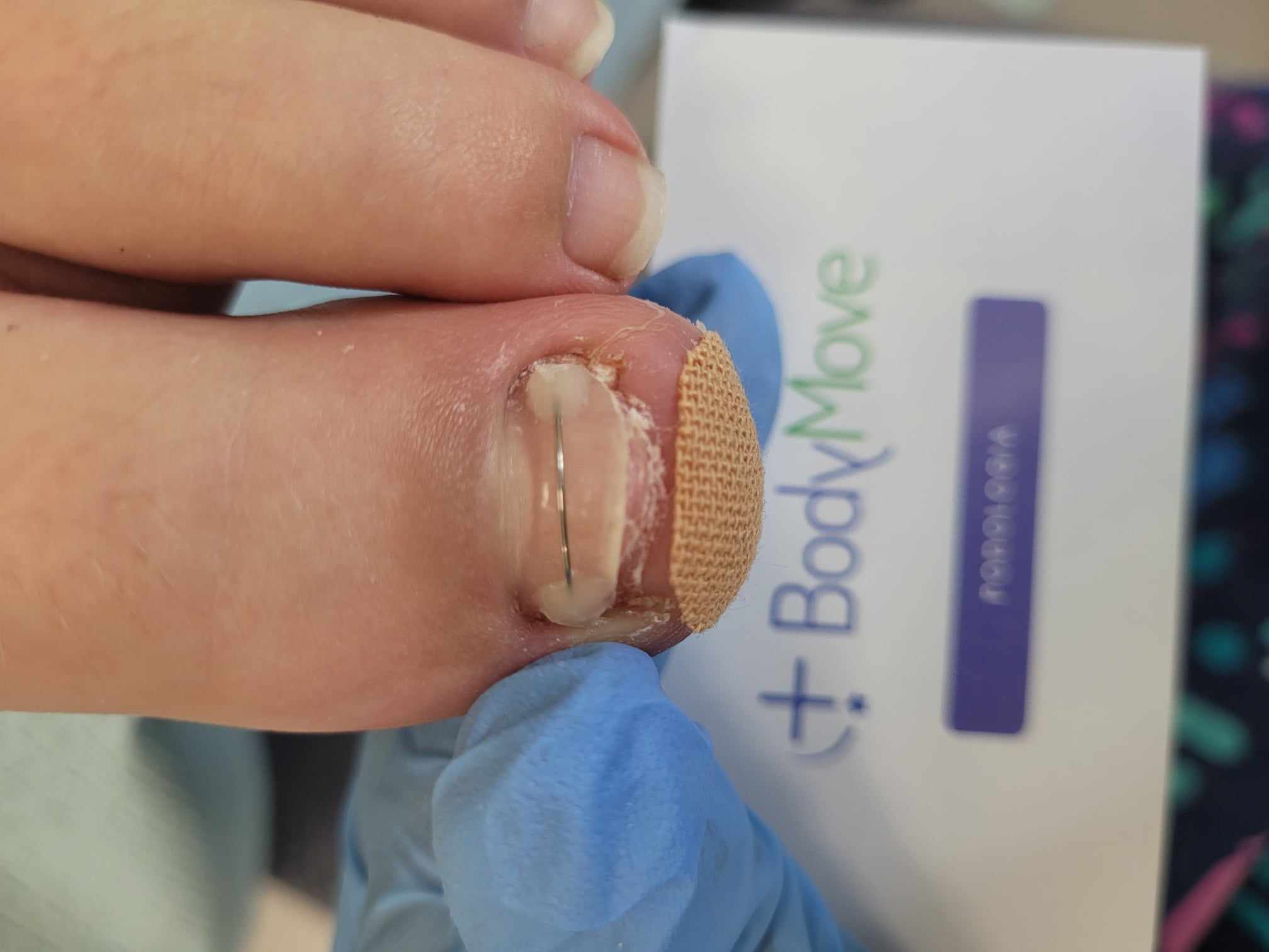 wrastajacy-paznokiec-klamra-leczenie